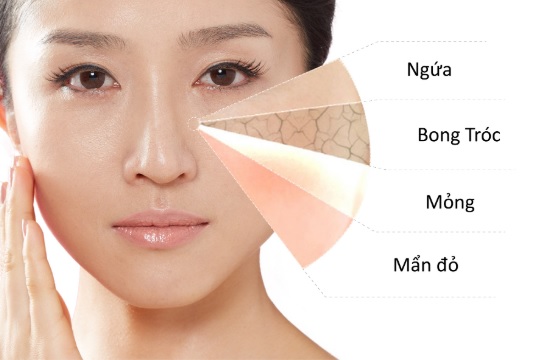 Làn da nhạy cảm thường rất dễ bị bong tróc, nhất là ở nơi có khí hậu khô, lạnh. Da khá mỏng, thậm chí có thể dễ dàng thấy các đường mạch máu dưới da. Vì da khá yếu và nhạy cảm với ánh nắng mặt trời, da nhạy cảm rất dễ bị bắt nắng dẫn đến ửng đỏ và rát da.